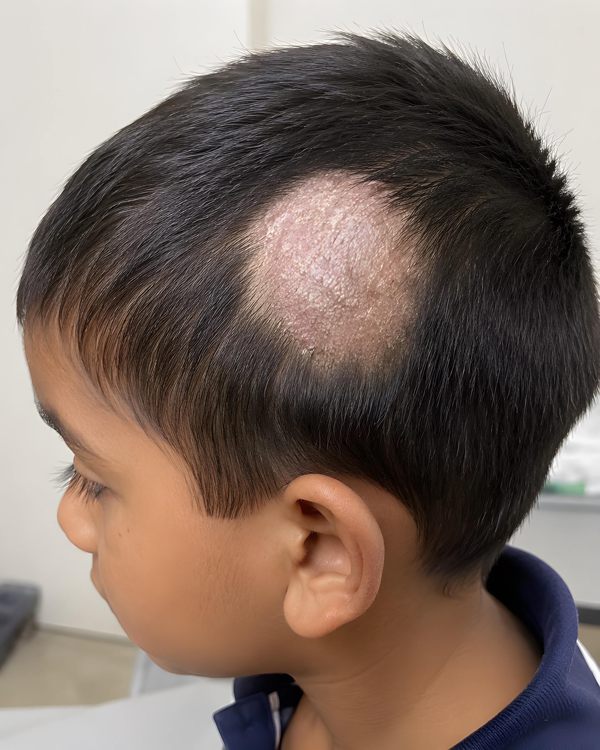You are currently viewing Alopecia areata in Children: When should parents consult a hairloss doctor?