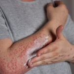 Why Do Hives Keep Coming Back? Understanding Chronic Urticaria
