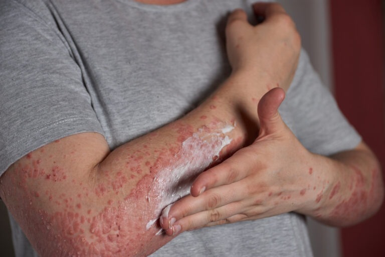 Chronic Urticaria