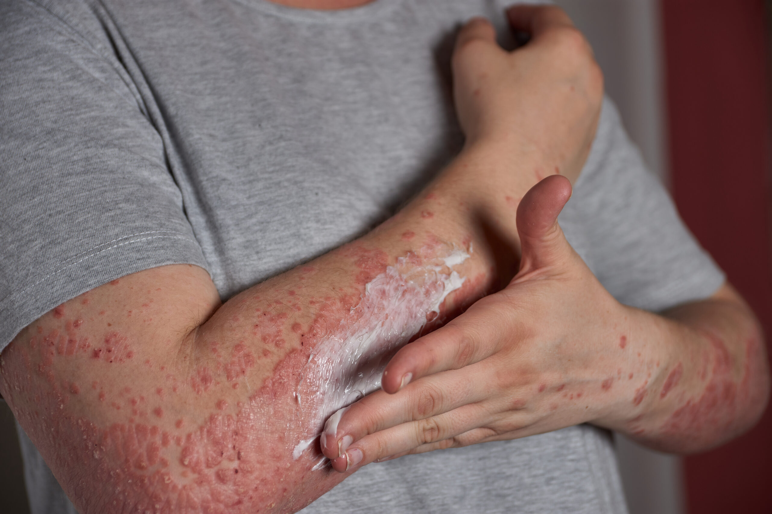You are currently viewing Why Do Hives Keep Coming Back? Understanding Chronic Urticaria