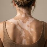 Early Signs of Vitiligo: What Does It Look Like at the Beginning?