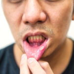 Why do mouth ulcers keep coming back? Causes and warning sign?