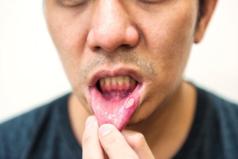 mouth ulcers keep coming back